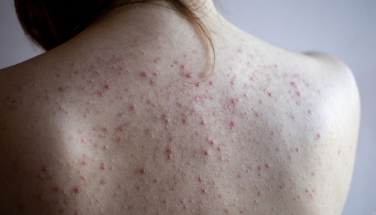 A woman's back, covered in acne.