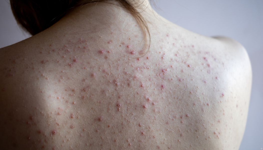 A woman's back, covered in acne.